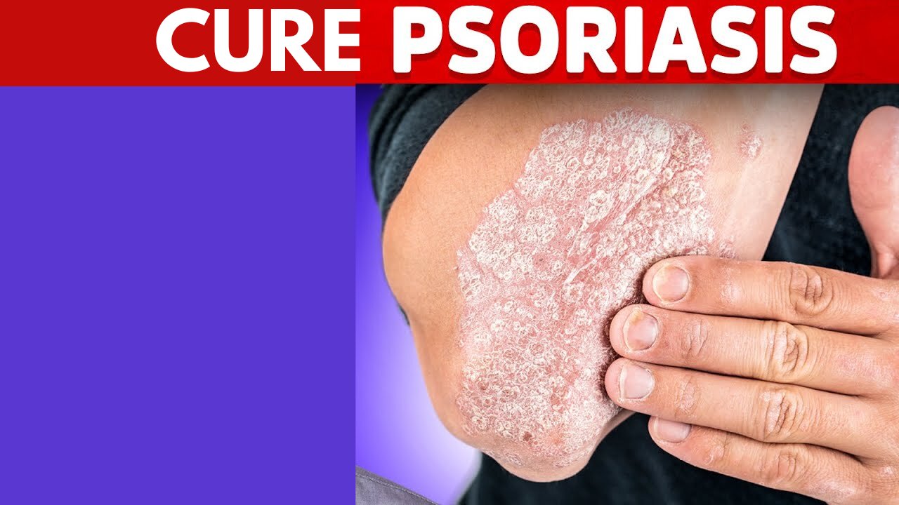 How to get rid of all types of Psoriasis