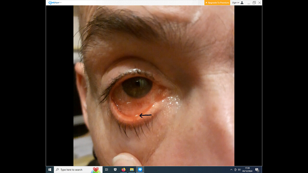 Major eye (cornea) abrasion. Why I might go off-air for a while