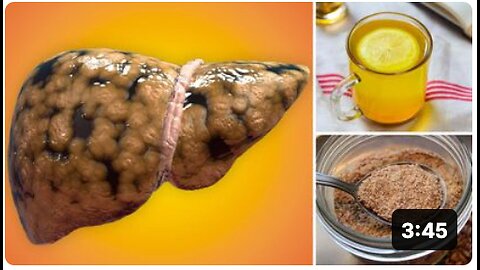 How to Treat Fatty Liver Disease Naturally at Home