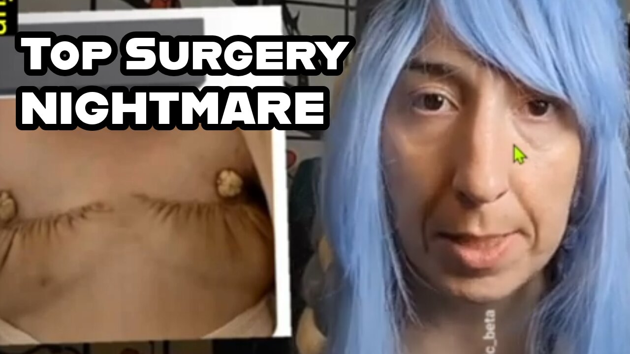 "The Bed Skirt" SAD Botched Top surgery review