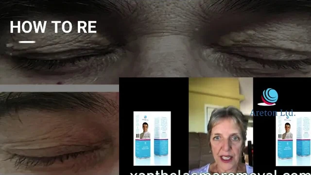 HOW TO REMOVE THE XANTHELASMA