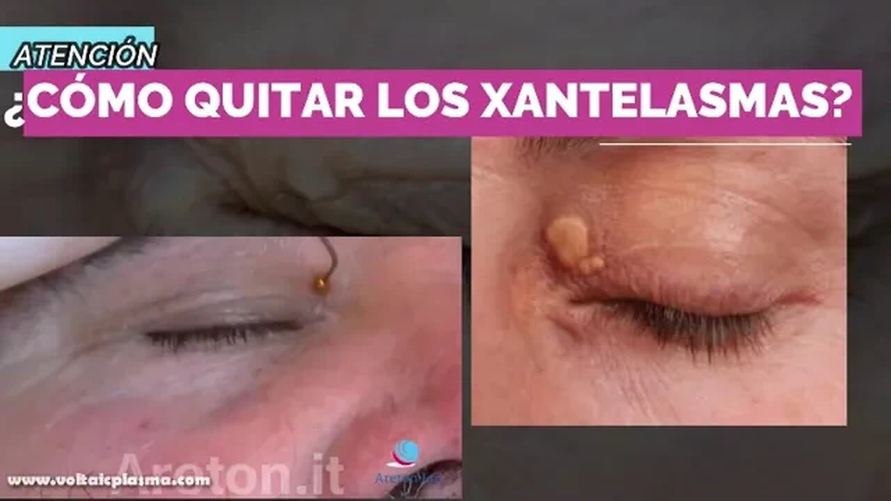 CÓMO QUITAR LOS XANTELASMAS