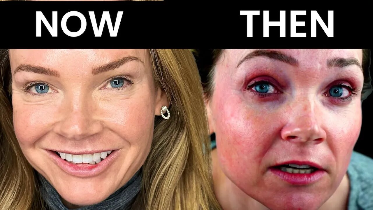 5 years Microneedling at Home Before and After Results