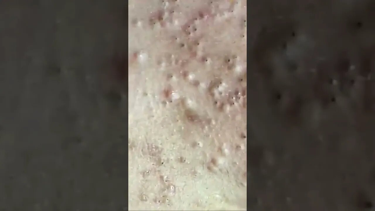 blackhead removal, blackheads, blackheads and acne, pimples removal, #short03
