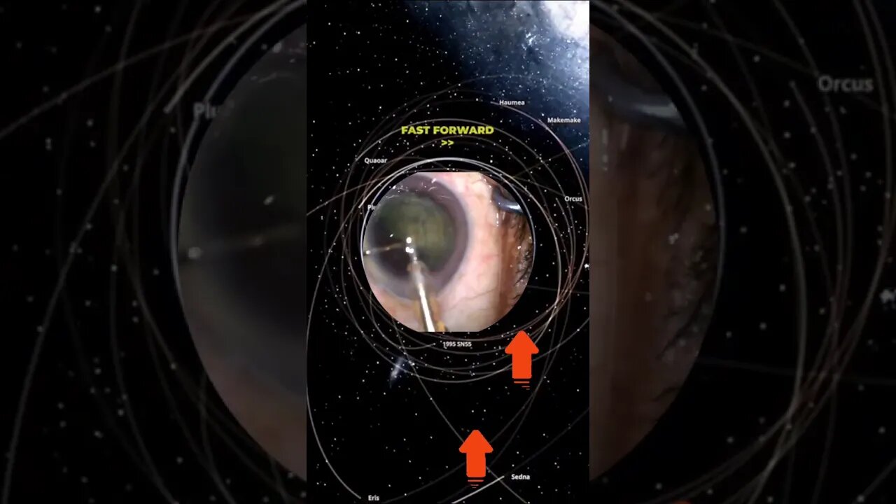 eye surgery - scroll rott #nonsense #zoobox #reddit #eyes #cataracts