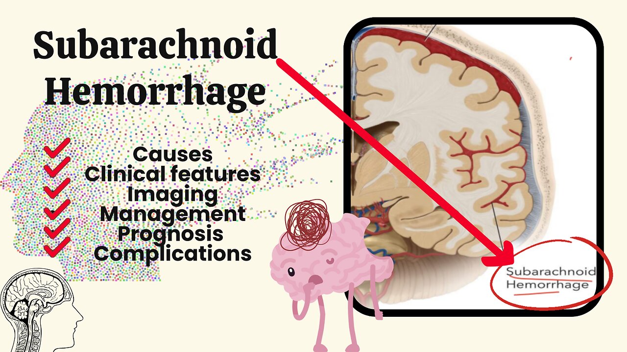 Subarachnoid Hemorrhage | Types, Cause, Clinical Features, CT Scan, Treatment | Hemorrhagic Stroke