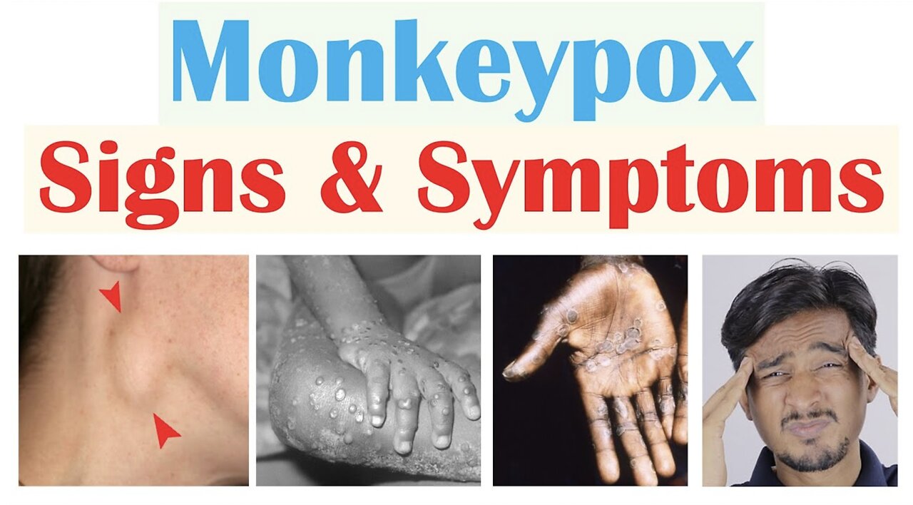 Monkeypox Signs & Symptoms (First Symptom & Stages of Rash)