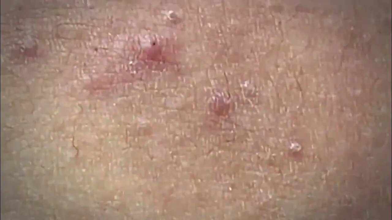 blackhead removal, blackheads, blackheads and acne, pimples removal, acne #26