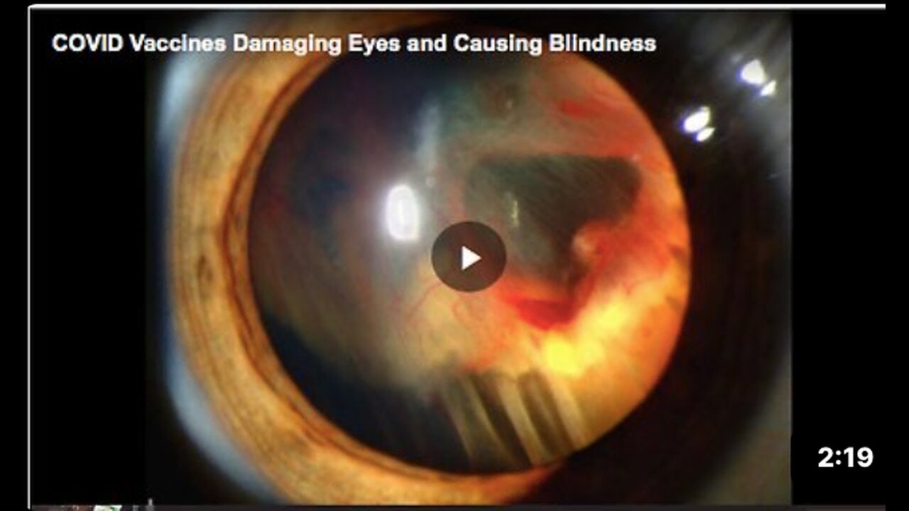 How the COVID-19 vaccines damage the eyes and cause blindness