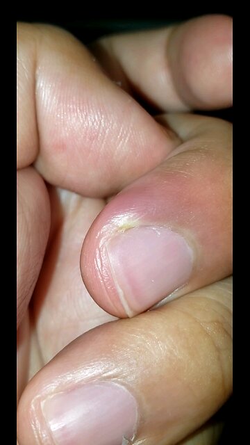 I got Paronychia and I feel so painful