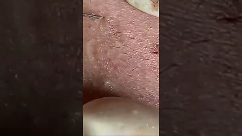 blackhead removal, blackheads, blackheads and acne, pimples removal, #short 50