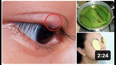 How to Get Rid of a Sty (Stye) - 4 Effective Home Remedies