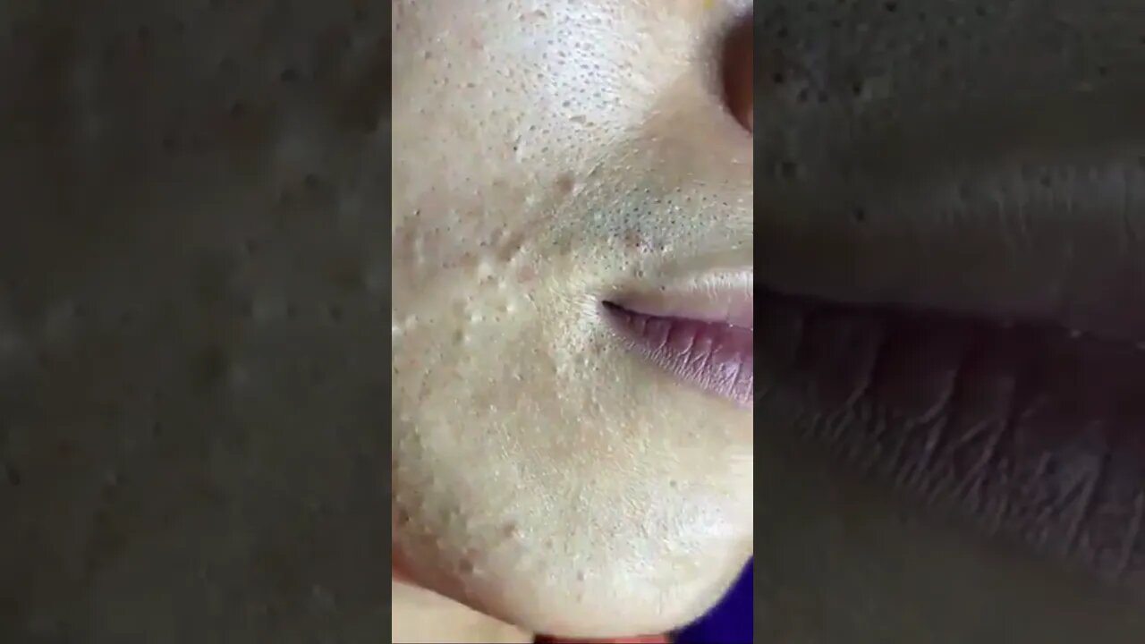 blackhead removal, blackheads, blackheads and acne, pimples removal, #short01