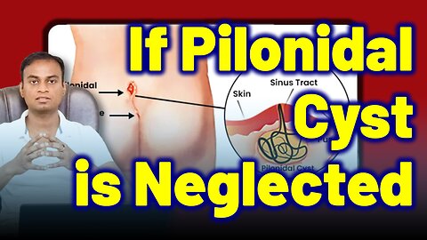 What Happens if You Neglect Pilonidal Cyst Sinus Abscesses? | Treatment Cure Medicine Surgery