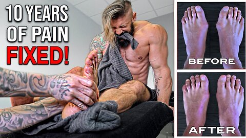 The WORST PAIN! | Fixing 10 YEARS Of Flat Feet & Bunions | AMAZING Results!