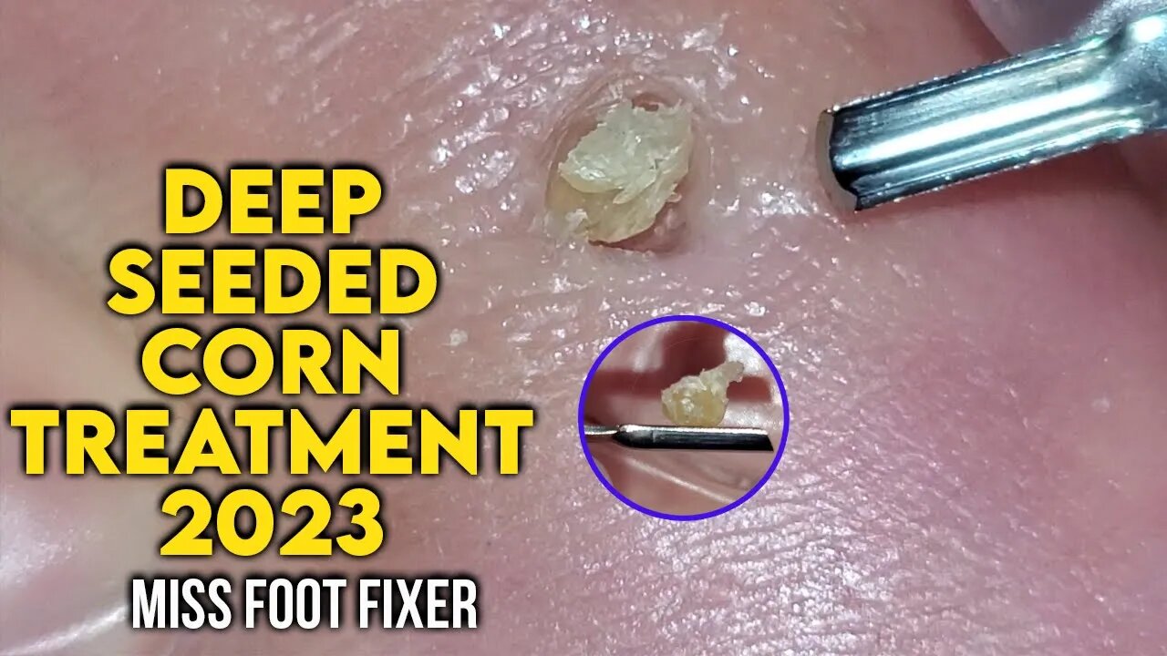 2023 - Podiatrist Removes Painful Deep Seeded Corn From Sole Of Feet [ MISS FOOT FIXER ]