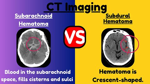 Subarachnoid Hematoma (SAH) vs. Subdural Hematoma (SDH): Key Differences Explained