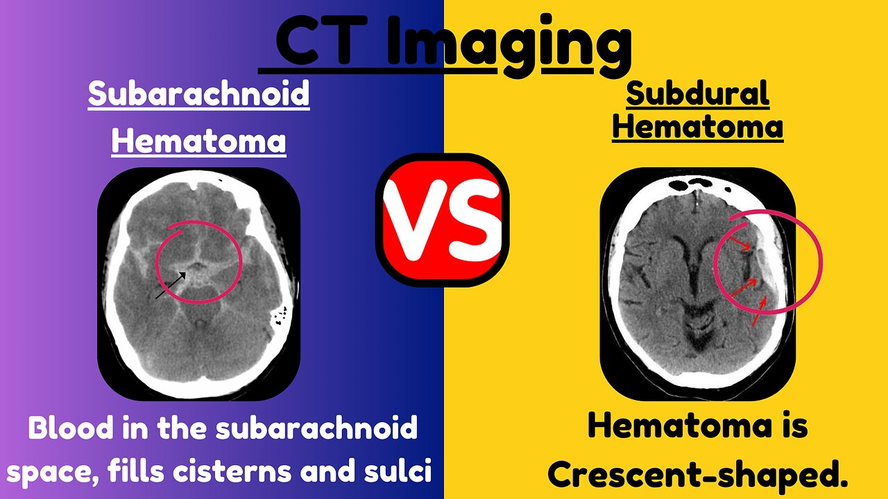 Subarachnoid Hematoma (SAH) vs. Subdural Hematoma (SDH): Key Differences Explained