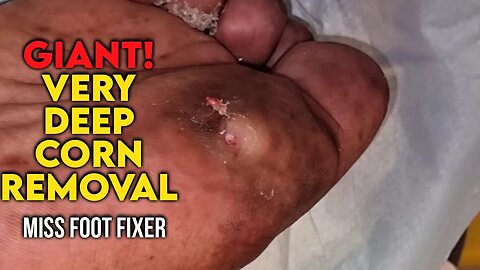 Giant! Very Deep Corn on Sole of Foot 2023 [ hard foot corn ] By Foot Specialist Miss Foot Fixer