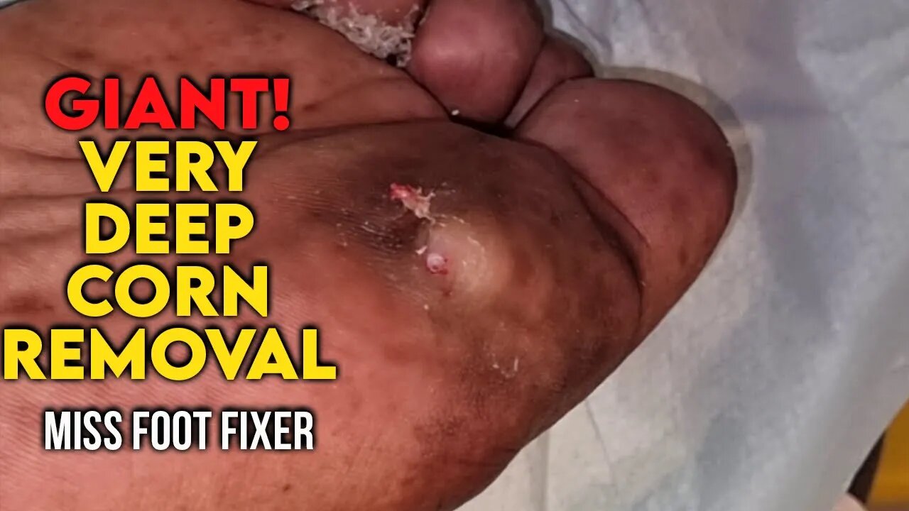 Giant! Very Deep Corn on Sole of Foot 2023 [ hard foot corn ] By Foot Specialist Miss Foot Fixer