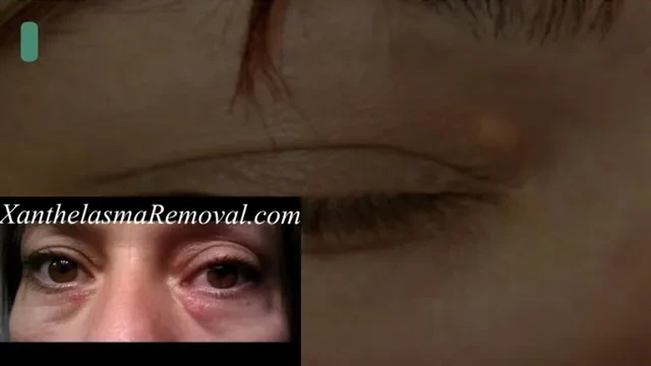 how to treat the xanthelasma