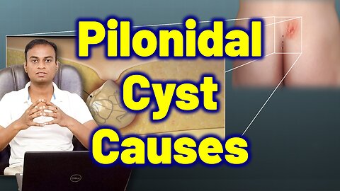 Risk Factors, Reasons, Causes for Pilonidal Cyst Sinus Abscesses | Treatment Cure Medicine Surgery