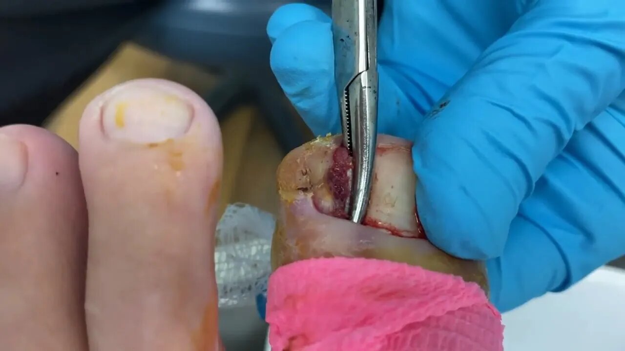 VÍDEO CHOCANTE DA UNHA ENCRAVADA MAIS EXTREMA | SHOCKING VIDEO OF THE MOST EXTREME INGROWN TOENAIL