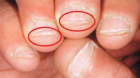 COMO PARAR DE ROER UNHAS: APLIQUE ESSAS DICAS PARA ACABAR COM O COSTUME