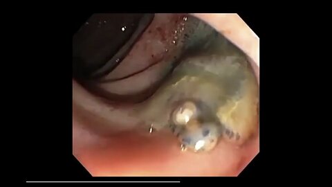 WORM 🐛 MOMENTS CAVITY SEARCH 🔍