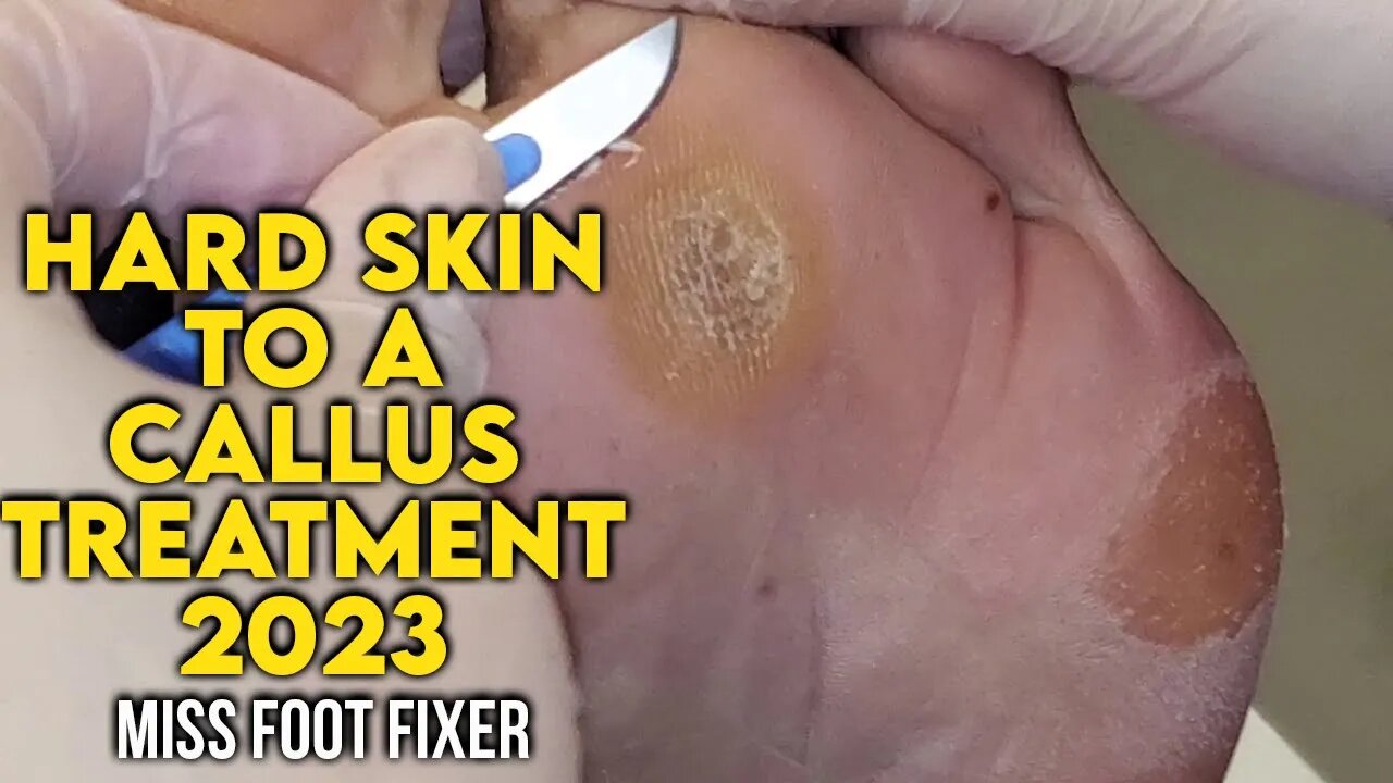 Hard Skin To a Callous - 🦶 Why Does This Happen ?? Full Treatment by Foot Specialist Miss Foot Fixer