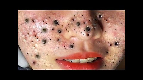 Satisfying blackhead removal, relaxing Pimple Popper 14567