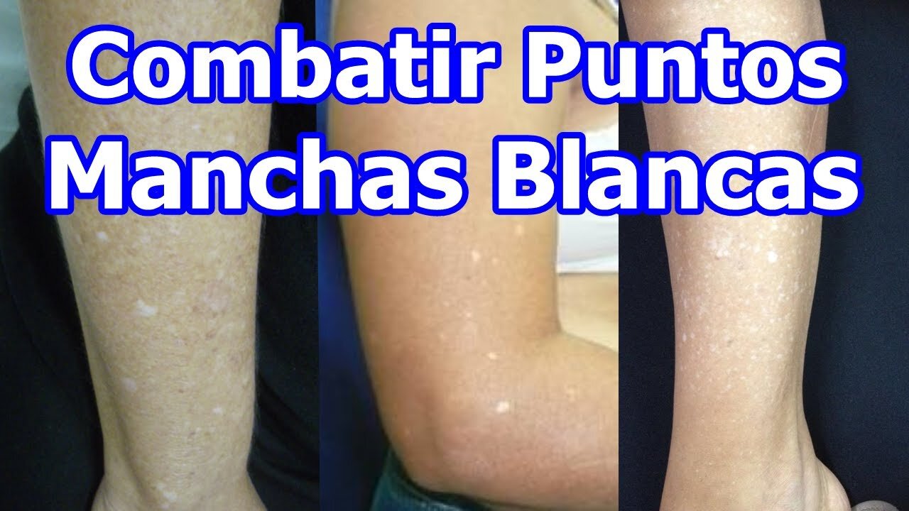 ELIMINAR MANCHAS Y PUNTOS BLANCOS DE LA PIEL Y LA CAUSA