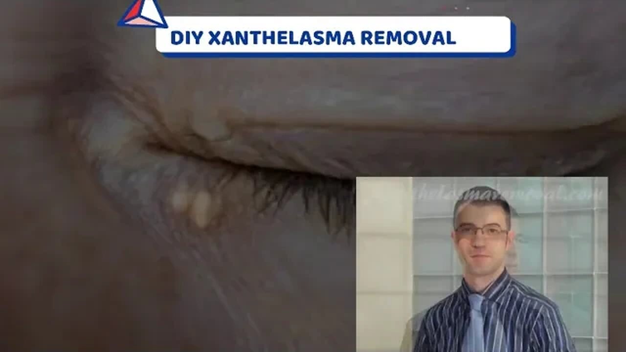 DIY XANTHELASMA REMOVAL