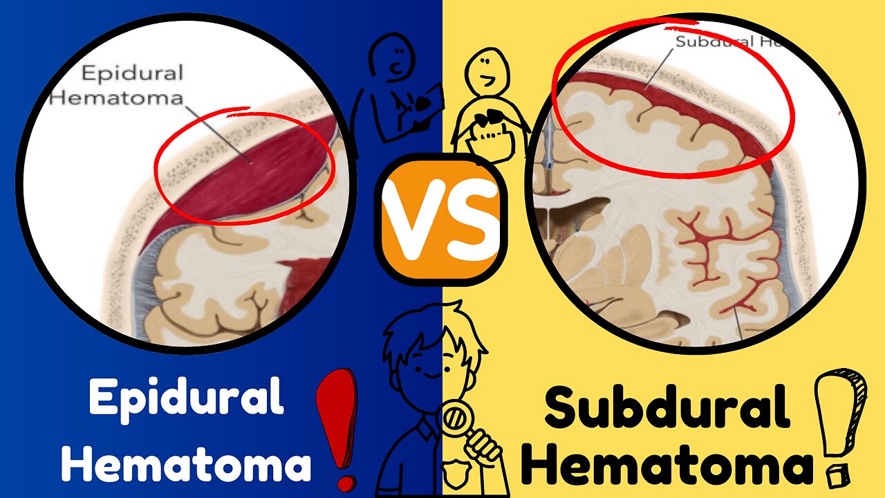 Epidural vs. Subdural Hematoma: Key Differences, Symptoms, and Clinical Insights