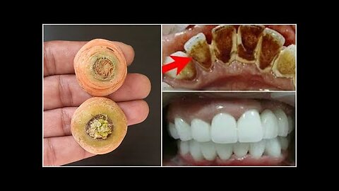 In 2 minutes, yellow will make dirty teeth white like pearl and shiny.Home remedy for teeth whitenin