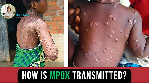 How is MPOX Transmitted? | DR. MAI