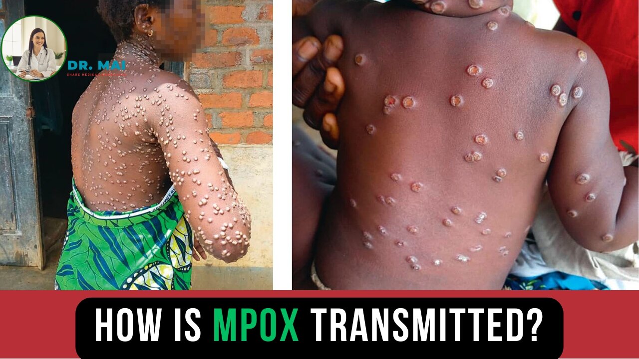 How is MPOX Transmitted? | DR. MAI