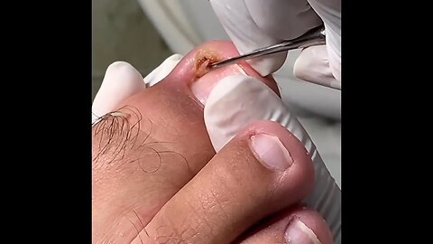 remoção de unha encravada podóloga meticulosa | meticulous podiatrist ingrown toenail removal #nails