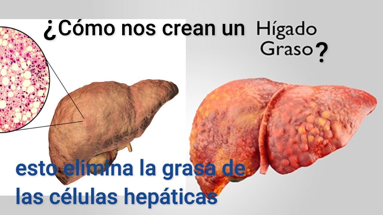 QUÉ ES LO QUE CREA EL HÍGADO GRASO, CÓMO ELIMINAR ESA GRASA Y REPARAR LAS CÉLULAS HEPÁTICAS