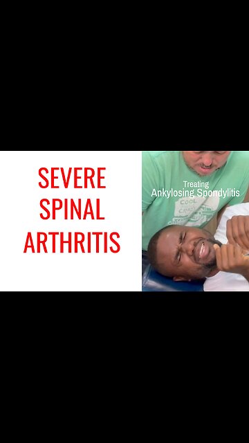 New Chiropractic Adjustment works for Severe Arthritis (Ankylosing Spondylitis)