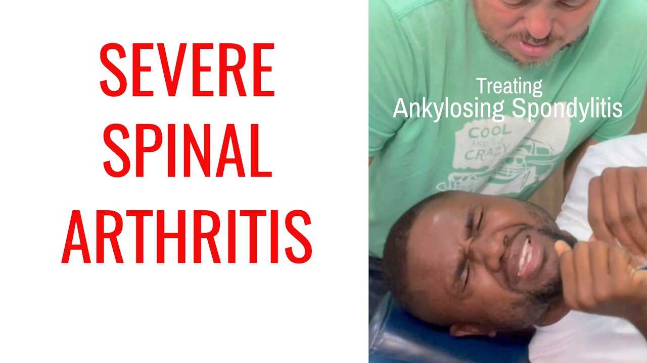 New Chiropractic Adjustment works for Severe Arthritis (Ankylosing Spondylitis)