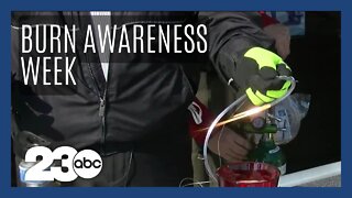 Warning for those on oxygen during Burn Awareness Week