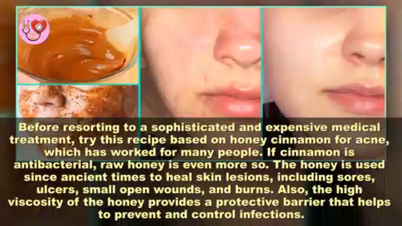 the-complete-guide-of-use-honey-and-cinnamon-for-acne-givefastlink