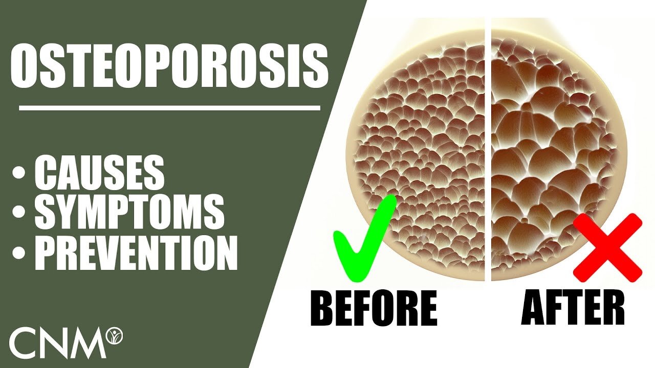 OSTEOPOROSIS: The Natural Way To Prevent It