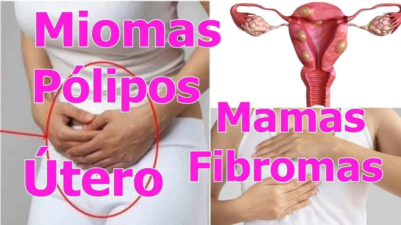 MIOMAS, PÓLIPOS EN EL ÚTERO Y FIBROMAS EN LAS MAMAS, CAUSAS Y COMO ELIMINAR