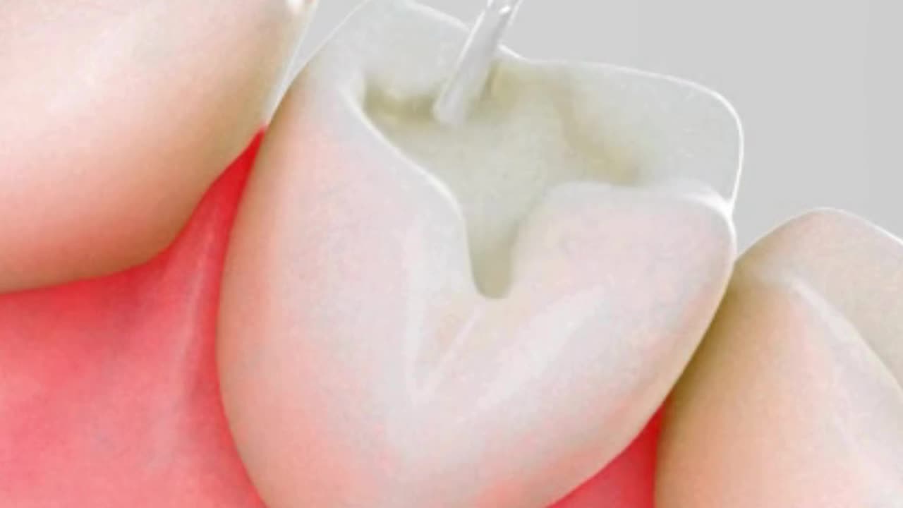 Trending tooth filling