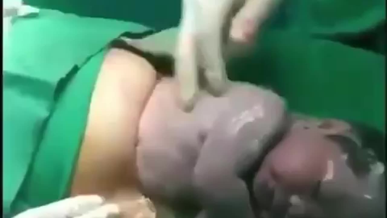 Incredible Birth by cesarean section…