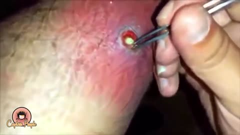 pimple popper.https://dinero77omega.blogspot.com/2023/01/rumble_31.html