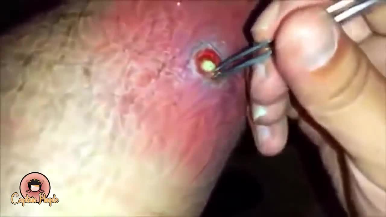 pimple popper.https://dinero77omega.blogspot.com/2023/01/rumble_31.html