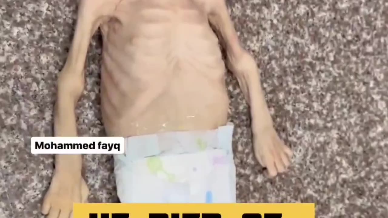 Forced Starvation in Gaza